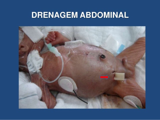 enterocolite necrotizante neonatal